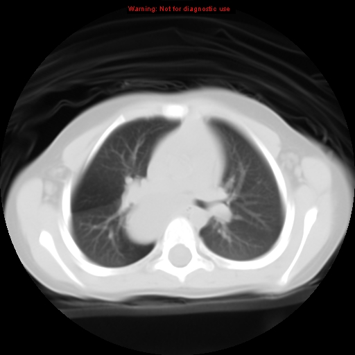 File:Bronchogenic cyst (Radiopaedia 9372-10063 Axial lung window 7).jpg