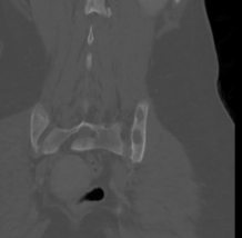 File:Brown tumor (Radiopaedia 12318-12596 C 1).jpg