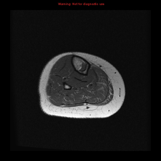 File:Brown tumor (Radiopaedia 12318-12597 Axial T1 28).jpg