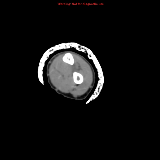 Brown tumor (Radiopaedia 12460-12694 Axial non-contrast 94).jpg
