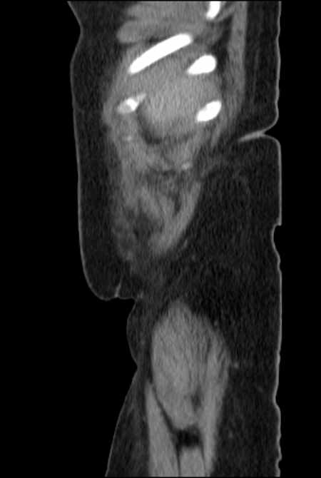 Brown tumors compressing the spinal cord (Radiopaedia 68442-77988 F 5).jpg