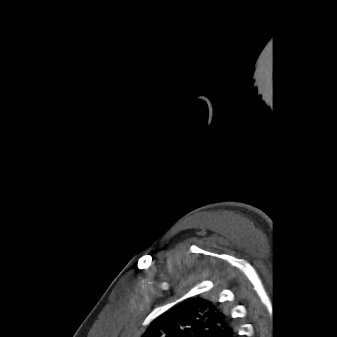 Buccal fat pad arteriovenous malformation (Radiopaedia 70936-81144 C 16).jpg