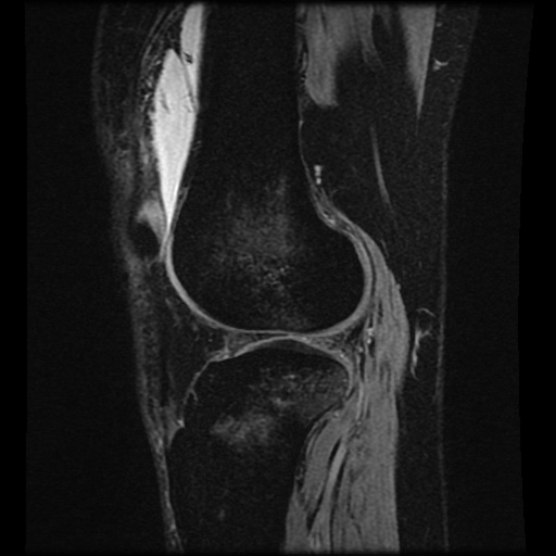 Bucket handle meniscus tear (Radiopaedia 56916-63751 H 24).jpg