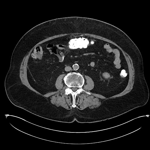 Buried bumper syndrome - gastrostomy tube (Radiopaedia 63843-72577 Axial Inject 60).jpg