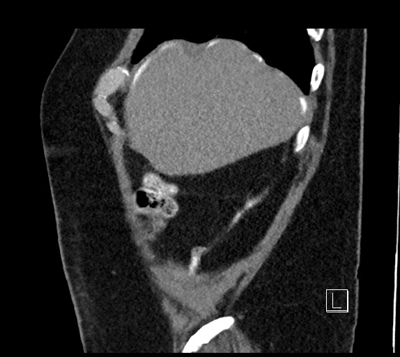 Buried bumper syndrome - gastrostomy tube (Radiopaedia 63843-72577 Sagittal Inject 105).jpg