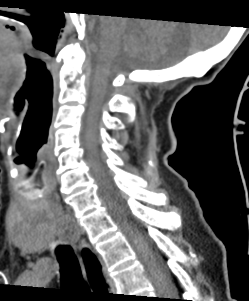 C2 fracture with vertebral artery dissection (Radiopaedia 37378-39199 D 40).png