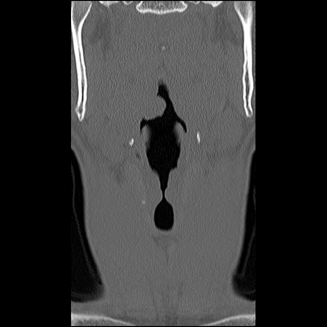 C5 facet fracture (Radiopaedia 58374-65499 Coronal bone window 12).jpg