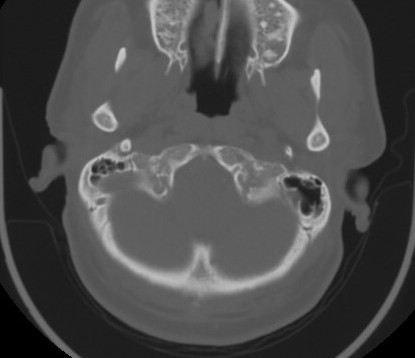 C7 laminar fracture and Klippel-Feil syndrome (Radiopaedia 86710-102850 Axial bone window 18).jpg