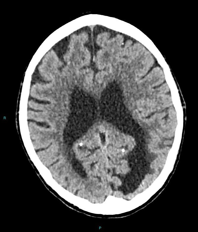 Calcified cerebral emboli from left ventricular thrombus (Radiopaedia 84420-99758 Axial non-contrast 39).jpg