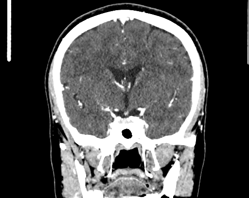 Calcified cerebral hydatid cyst (Radiopaedia 65603-74717 C 30).jpg