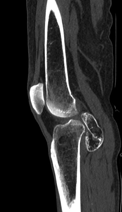Calcified hematoma - popliteal fossa (Radiopaedia 63938-72763 Sagittal bone window 63).jpg