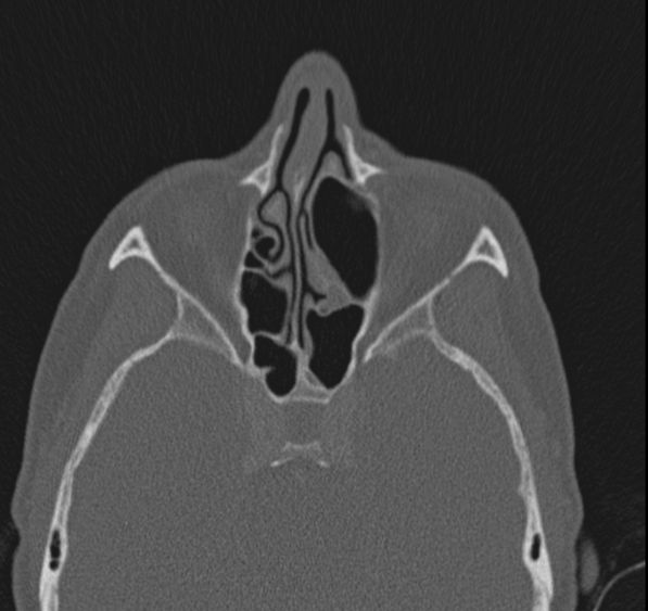 Caldwell-Luc operation (Radiopaedia 52329-58225 Axial bone window 27).jpg