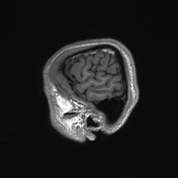 File:Callosal dysgenesis with interhemispheric cyst (Radiopaedia 53355-59335 Sagittal T1 159).jpg