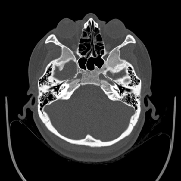 Calvarial osteoma (Radiopaedia 36520-38079 Axial bone window 25).jpg