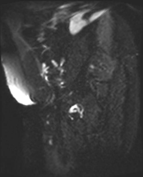 Cancer cervix - stage IIb (Radiopaedia 75411-86615 Sagittal DWI 23).jpg
