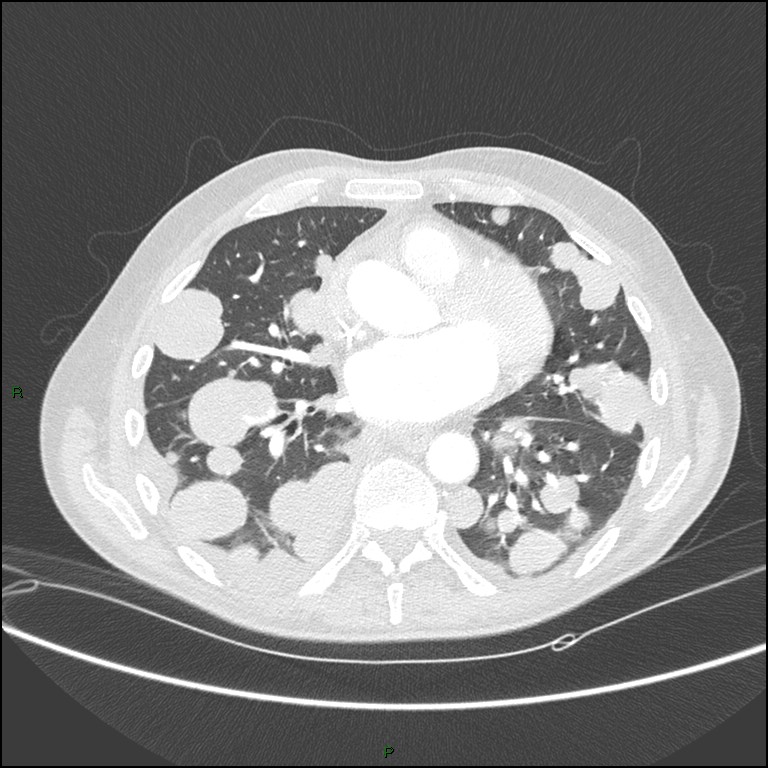 Cannonball metastases (Radiopaedia 82110-96150 Axial lung window 116).jpg