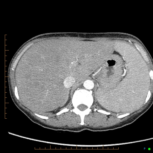 Canonball lung metastasis (Radiopaedia 77634-89837 B 101).jpg