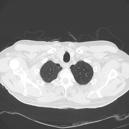 Caplan syndrome (Radiopaedia 56667-63530 Axial lung window 27).jpg