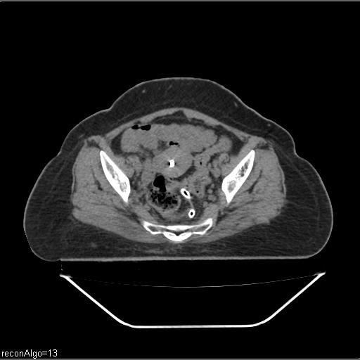 Carcinoma cervix- brachytherapy applicator (Radiopaedia 33135-34173 Axial non-contrast 21).jpg