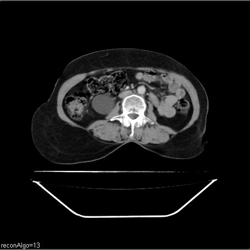 File:Carcinoma cervix- recurrence (Radiopaedia 34702-36137 B 28).jpg