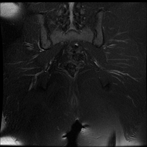 File:Carcinoma of the cervix (Radiopaedia 89018-105858 Coronal T2 fat sat 14).jpg