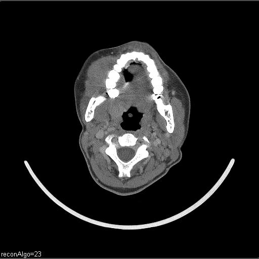 Carcinoma of the maxillary antrum (Radiopaedia 53805-59888 Axial C+ delayed 39).jpg