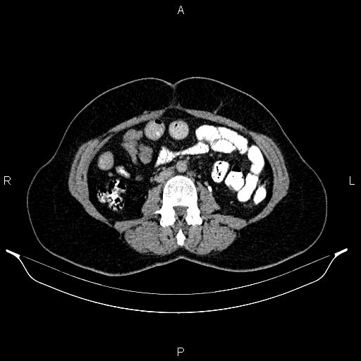 File:Carcinoma of uterine cervix (Radiopaedia 85861-101700 Axial C+ delayed 40).jpg