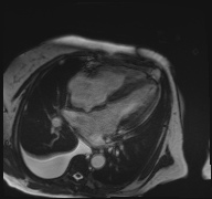 File:Cardiac amyloidosis (Radiopaedia 51404-57150 A 14).jpg