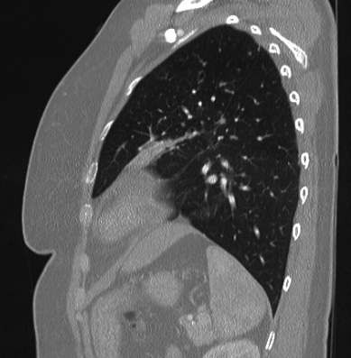 Cardiac sarcoidosis (Radiopaedia 74548-85534 Sagittal lung window 22).jpg