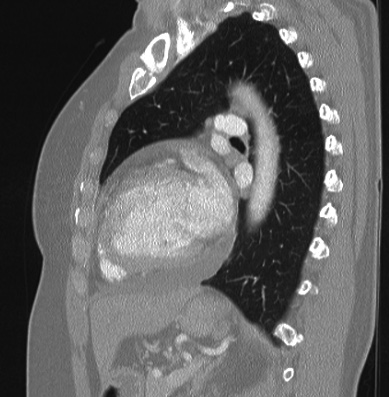 Cardiac sarcoidosis (Radiopaedia 74548-85534 Sagittal lung window 35).jpg