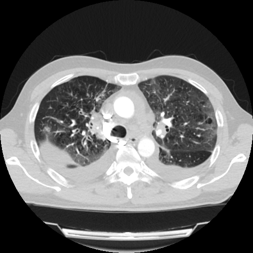 Cardiac tamponade (Radiopaedia 78607-91368 Axial lung window 26).jpg