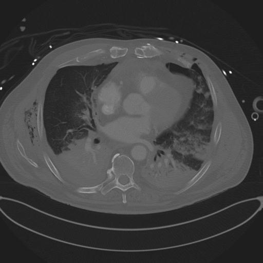Cardiac trauma (Radiopaedia 32874-33858 Axial bone window 52).jpg