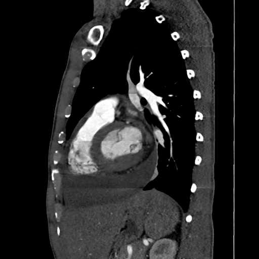 Cardiac tumor - undifferentiated pleomorphic sarcoma (Radiopaedia 45844-50134 B 26).png