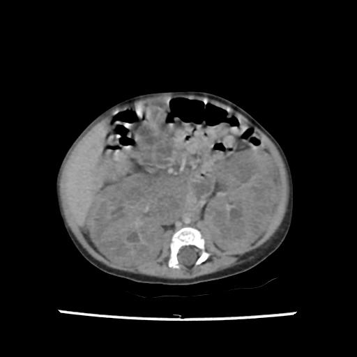 Caroli disease with autosomal recessive polycystic kidney disease (ARPKD) (Radiopaedia 89651-106703 B 122).jpg