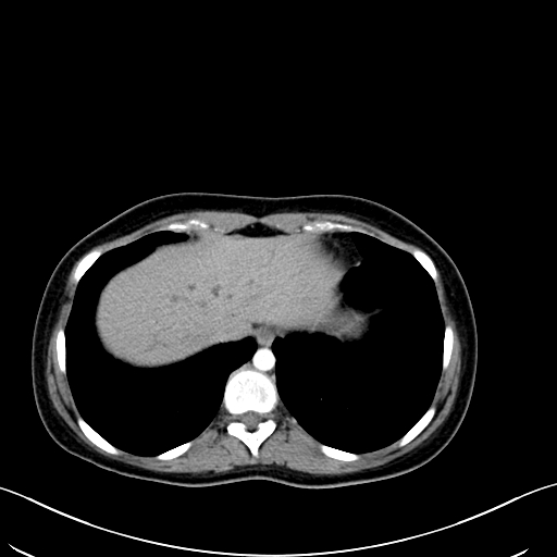 File:Caroli disease with medullary sponge kidney (Radiopaedia 82622-96804 C 13).jpg