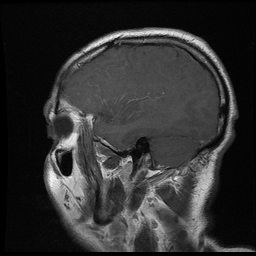File:Carotid arterial dissection with acute cerebral infarction (Radiopaedia 26636-26784 Sagittal T1 C+ 16).jpg