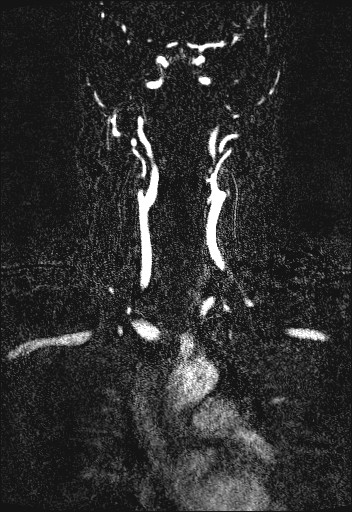 Carotid artery dissection (Radiopaedia 28441-28689 Coronal MRA 37).jpg