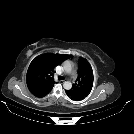 File:Carotid body tumor (Radiopaedia 21021-20948 A 33).jpg