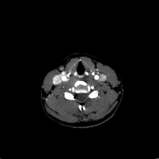 File:Carotid body tumor (Radiopaedia 39845-42300 B 12).jpg