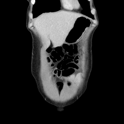 Castleman disease with fibrous pseudotumor in the abdomen (Radiopaedia 77296-89373 B 17).jpg