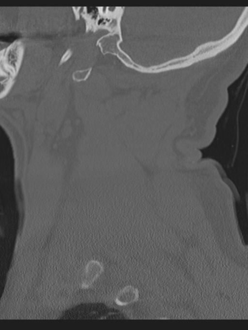 Cavernoma of cervical cord (Radiopaedia 50838-56346 Sagittal bone window 14).png