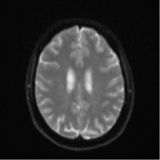 File:Cavernoma with bleed - midbrain (Radiopaedia 54546-60774 Axial DWI 18).png