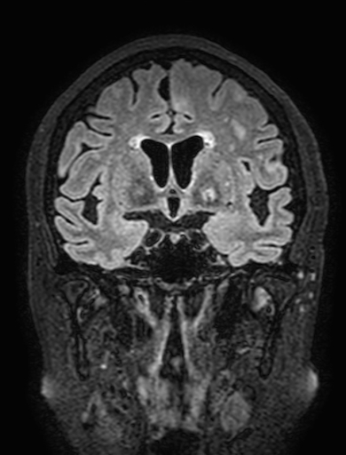 Cavernous hemangioma of the cerebellar falx (Radiopaedia 73025-83724 Coronal FLAIR 145).jpg