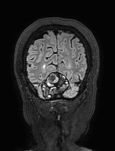 Cavernous hemangioma of the cerebellar falx (Radiopaedia 73025-83724 Coronal FLAIR 310).jpg