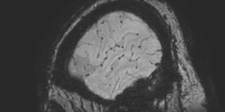 Cavernous hemangioma of the cerebellar falx (Radiopaedia 73025-83724 Sagittal BOLD 184).jpg