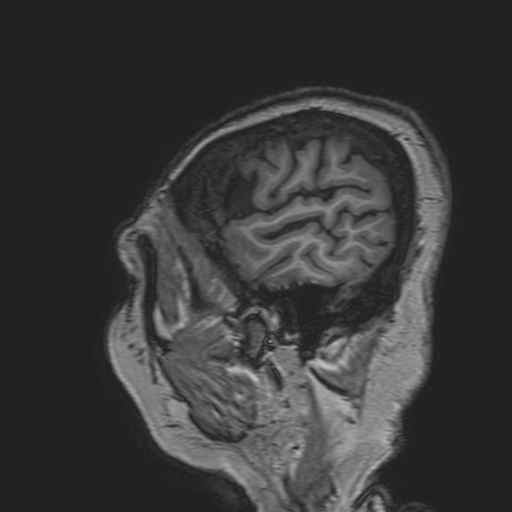 File:Cavernous hemangioma of the cerebellar falx (Radiopaedia 73025-83724 Sagittal T1 27).jpg