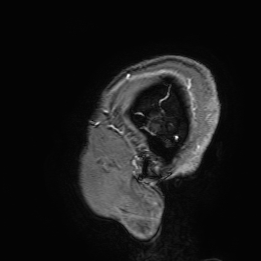 File:Cavernous hemangioma of the cerebellar falx (Radiopaedia 73025-83724 Sagittal T1 C+ 202).jpg