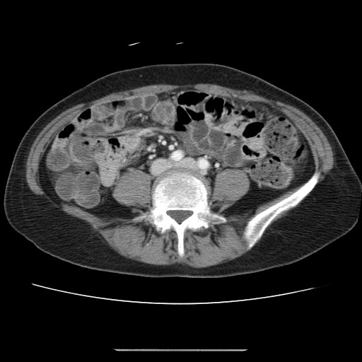 Cavernous hepatic hemangioma (Radiopaedia 75441-86667 B 73).jpg