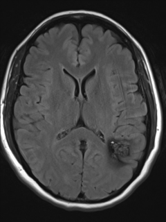 File:Cavernous malformation (cavernous angioma or cavernoma) (Radiopaedia 36675-38237 Axial T2 FLAIR 12).png