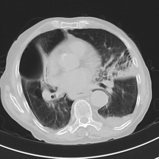 Cavitating pneumonia - lingular segments (Radiopaedia 34386-35678 Axial lung window 35).png